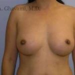 Breast Augmentation Before & After Patient #8973
