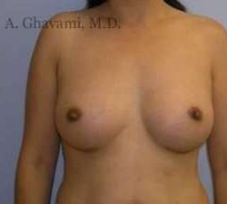 Breast Augmentation Before & After Patient #8973