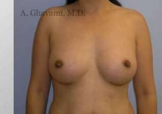 Breast Augmentation Before & After Patient #8973