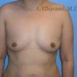 Breast Augmentation Before & After Patient #8973