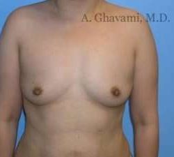 Breast Augmentation Before & After Patient #8973