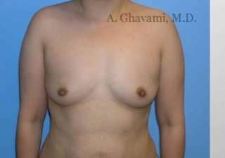 Breast Augmentation Before & After Patient #8973