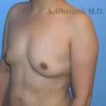 Breast Augmentation Before & After Patient #8973