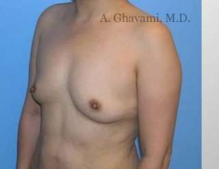 Breast Augmentation Before & After Patient #8973