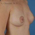Breast Augmentation Before & After Patient #8968