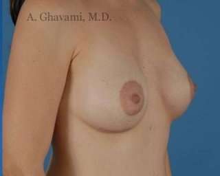Breast Augmentation Before & After Patient #8968