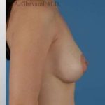Breast Augmentation Before & After Patient #8968