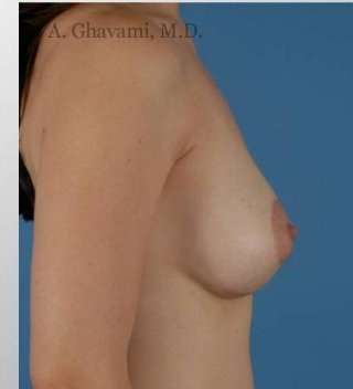 Breast Augmentation Before & After Patient #8968