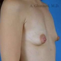 Breast Augmentation Before & After Patient #8968