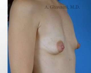 Breast Augmentation Before & After Patient #8968