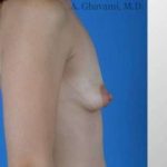Breast Augmentation Before & After Patient #8968