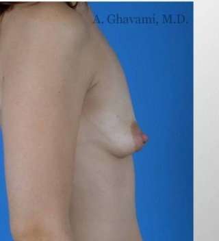 Breast Augmentation Before & After Patient #8968