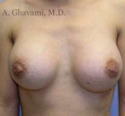 Breast Augmentation Before & After Patient #8963