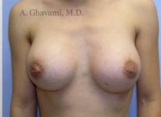 Breast Augmentation Before & After Patient #8963
