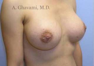 Breast Augmentation Before & After Patient #8963
