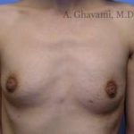 Breast Augmentation Before & After Patient #8963