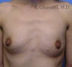 Breast Augmentation Before & After Patient #8963