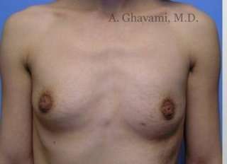 Breast Augmentation Before & After Patient #8963