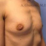 Breast Augmentation Before & After Patient #8963
