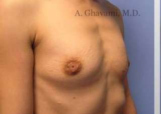 Breast Augmentation Before & After Patient #8963
