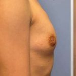 Breast Augmentation Before & After Patient #8963