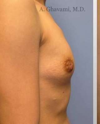 Breast Augmentation Before & After Patient #8963