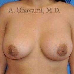 Breast Augmentation Before & After Patient #8956