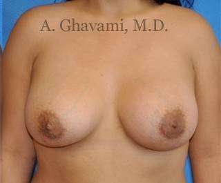 Breast Augmentation Before & After Patient #8956