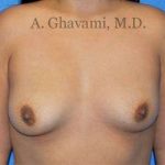 Breast Augmentation Before & After Patient #8956