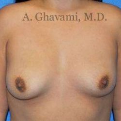 Breast Augmentation Before & After Patient #8956