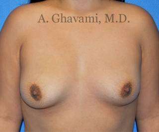 Breast Augmentation Before & After Patient #8956
