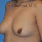 Breast Augmentation Before & After Patient #8956