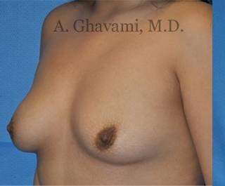 Breast Augmentation Before & After Patient #8956