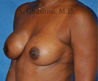 Breast Augmentation Before & After Patient #8951