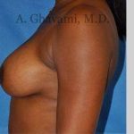 Breast Augmentation Before & After Patient #8951