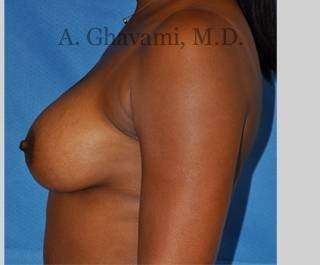 Breast Augmentation Before & After Patient #8951