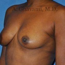 Breast Augmentation Before & After Patient #8951