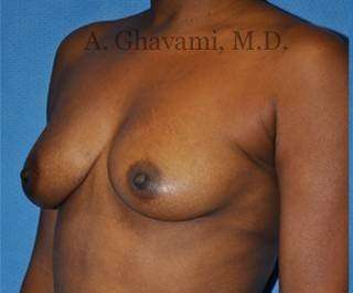 Breast Augmentation Before & After Patient #8951