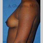 Breast Augmentation Before & After Patient #8951