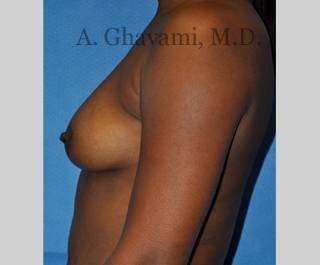 Breast Augmentation Before & After Patient #8951