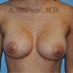 Breast Augmentation Before & After Patient #8946