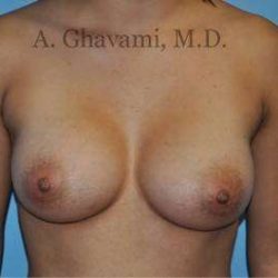 Breast Augmentation Before & After Patient #8946
