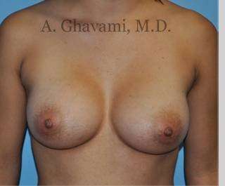 Breast Augmentation Before & After Patient #8946