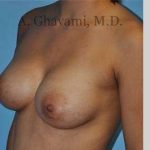 Breast Augmentation Before & After Patient #8946