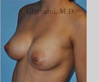 Breast Augmentation Before & After Patient #8946