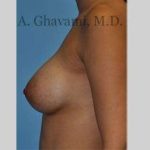 Breast Augmentation Before & After Patient #8946