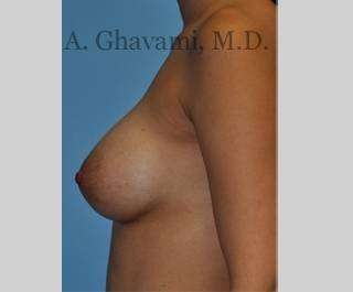 Breast Augmentation Before & After Patient #8946