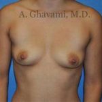Breast Augmentation Before & After Patient #8946