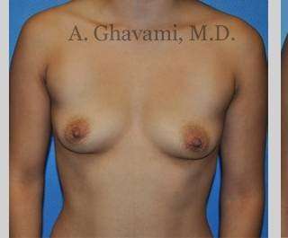 Breast Augmentation Before & After Patient #8946