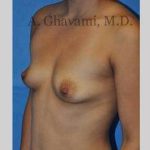 Breast Augmentation Before & After Patient #8946
